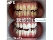 ホワイトニングサロン 福岡天神店/ホワイトニング