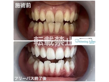 ホワイトニングサロン 福岡天神店/ホワイトニング
