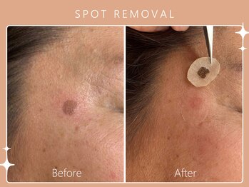 ハノハノ 八代店(HANO HANO)/気になるシミ、何個でもぺろん☆