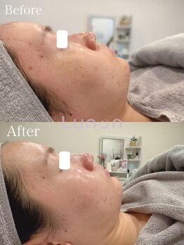 ルノン(Lunon)/毛穴洗浄ハイドロ×ララピール