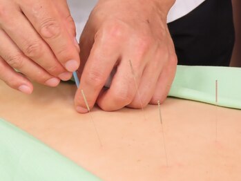 鍼灸治療院養源堂 西小山院/ピンポイント鍼施術