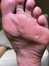 フットメンテ 巻き爪矯正センター 南浦和/魚の目スッキリ