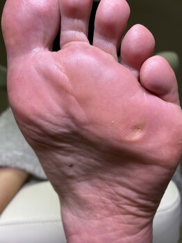 フットメンテ 巻き爪矯正センター 南浦和/魚の目スッキリ