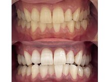 ホワイト 福岡天神店(WHITE)/ホワイトニングビフォーアフター