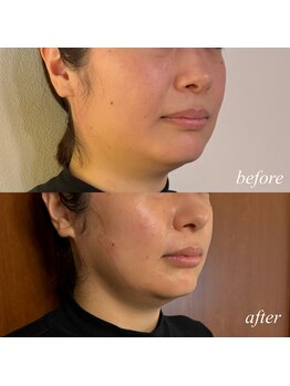 エン(en.)/フェイスラインスッキリ☆