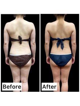 クールヴィラ(Cool Villa)/腕2カップ&ブラ線上下2カップ