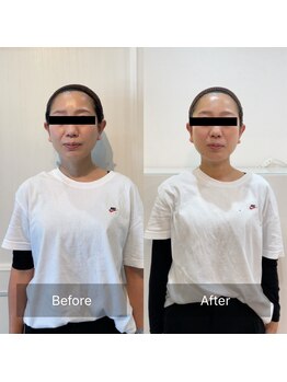 ククナ(Kukuna)/1回の施術で小顔へ★