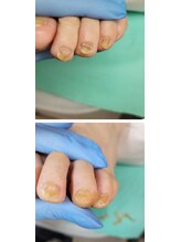 巻き爪補正店 西宮北口店/変形爪再生補正
