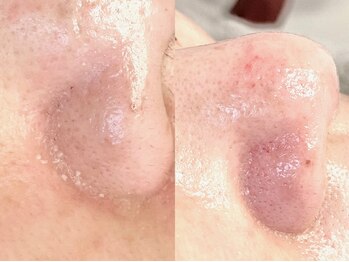 アイラッシュサロン ココ(CoCo)/毛穴エクストラクションプロ