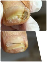 プラスキュア 用賀店(+CURE)/巻き爪矯正【1爪】＋爪切￥8800