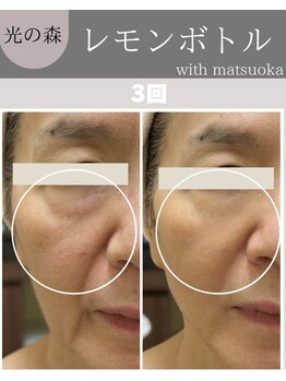 ウィズマツオカ 光の森店/レモンボトル(3回)効果写真
