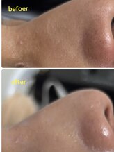 ひびき 京都烏丸御池店/お鼻の毛穴の黒ずみもクリアに!