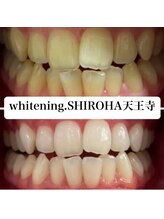 シロハ(SHIROHA)/セルフホワイトニング/天王寺
