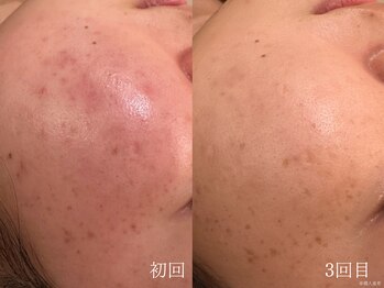 ウォーム(warm)/乾燥/敏感肌/赤み/フェイシャル