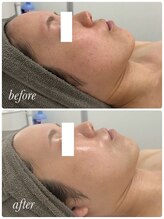ベルフィーヌボーテ(BELFINE beaute)/クリスティーナ赤み、ニキビ