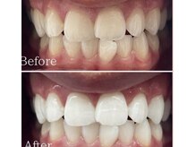 ホワイト 福岡天神店(WHITE)/ホワイトニングビフォーアフター