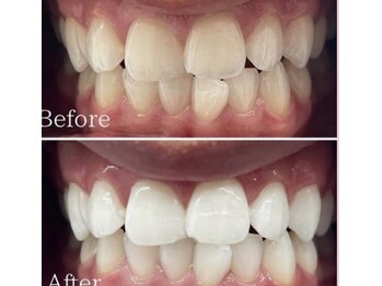 ホワイト 福岡天神店(WHITE)/ホワイトニングビフォーアフター