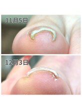 キャンディベース フクシマ(Candybase Fukushima)/巻き爪ケアもおまかせください！