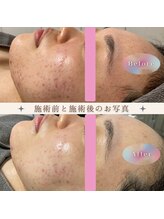 ルルーディア(LOULOUDIA)/ニキビケア施術1回