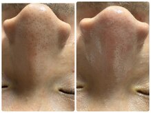 ルクシア(RUXCIA)/ビフォーアフター/毛穴洗浄1回