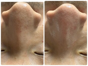 ルクシア(RUXCIA)/ビフォーアフター/毛穴洗浄1回