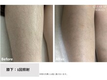 ニコ(Nico)/足脱毛