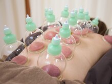 メディカル整体院 しろくま堂の雰囲気（カッピング（吸い玉・吸角）で老廃物を浮上させ血の巡りを促進！）