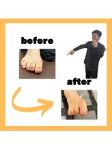 とくしま整体院 藍住院/巻き爪施術