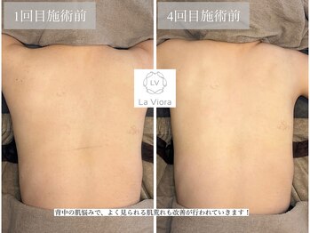 ラヴィオーラ 福島野田店(La Viora)/ダイヤモンドハーブピーリング