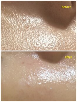 ひびき 京都烏丸御池店/毛穴洗浄+プラズマフェイシャル