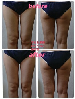 ペルラ(Perla)/痩身マシンのビフォーアフター♪