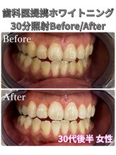 プラチナムビューティ 四条烏丸店(PLATINUM Beauty)/ホワイトニング！Before./After!