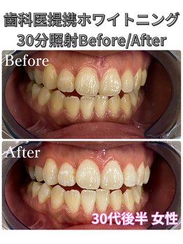 プラチナムビューティ 四条烏丸店(PLATINUM Beauty)/ホワイトニング!Before./After!