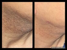 ビユ 大泉店(BIYU)/ヒゲ脱毛