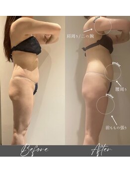 インフィニーズ(INFINEEZ)/カスタマイズ1ヶ月集中痩身40代