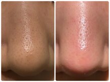 ルクシア(RUXCIA)/ビフォーアフター/毛穴洗浄1回