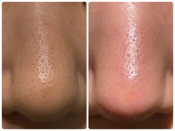 ルクシア(RUXCIA)/ビフォーアフター/毛穴洗浄1回