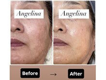 サロン ド アンジェリーナ(Salon de Angelina)/シミのお悩み改善