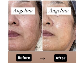 サロン ド アンジェリーナ(Salon de Angelina)/シミのお悩み改善