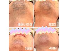 脱毛サロン ティアレ(Tiare)