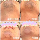 脱毛サロン ティアレ(Tiare)