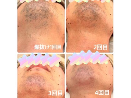 脱毛サロン ティアレ(Tiare)の写真