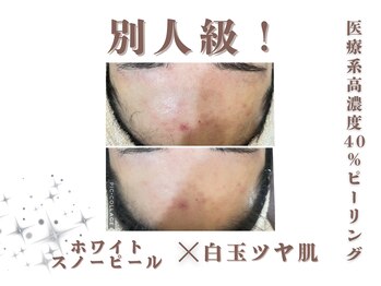 エステティック レイビス 銀座店(RAYVIS)/スノーピール