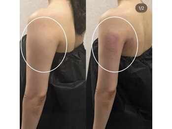 ミロク(369)/脂肪分解成分ジェット導入