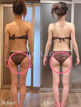 ルノン(Lunon)/ブライダルエステ