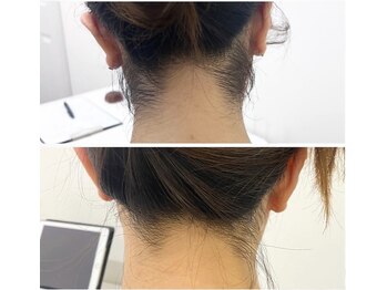 ミース 久留米店/うなじ脱毛体験1回目！