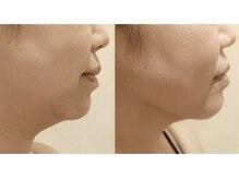 ワイグレイス(Y.GRACE)の雰囲気（【リアボーテ】小顔/リフトアップ/たるみ/毛穴/シミ/美肌/艶肌）