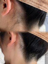 アトリーチェ ベレッツァ(ATTRICE Bellezza)/全身美肌脱毛