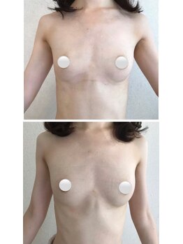 美人バスト 浦和店/【バストアップ★育乳】症例