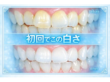 ココホワイトニング(coco whitening)の写真
